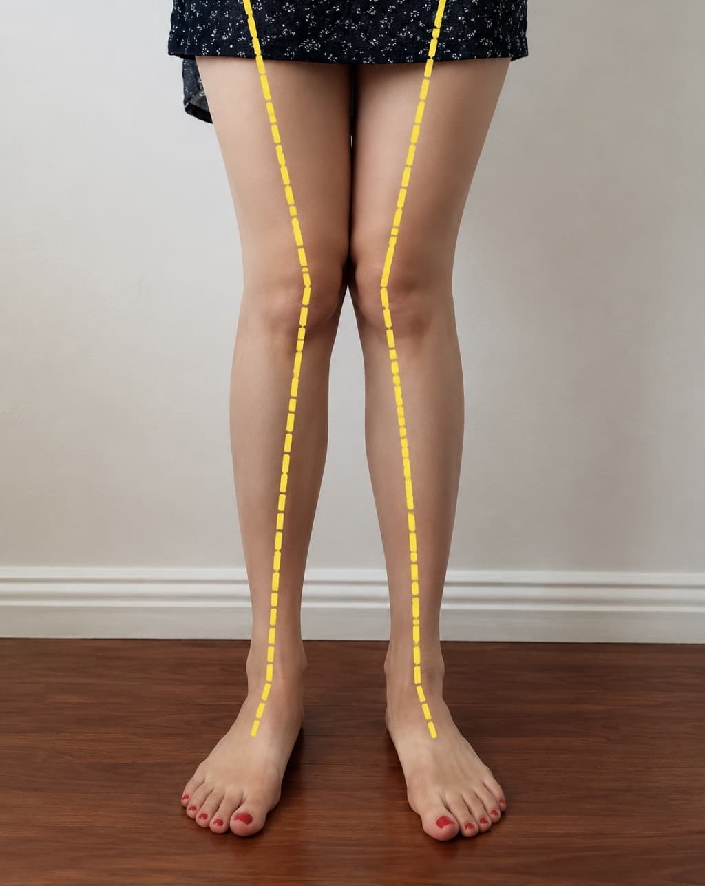 A child's legs from the front, with guide lines marking how the knees deviate from a straight axis.